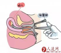 无痛人流的症状有哪些？