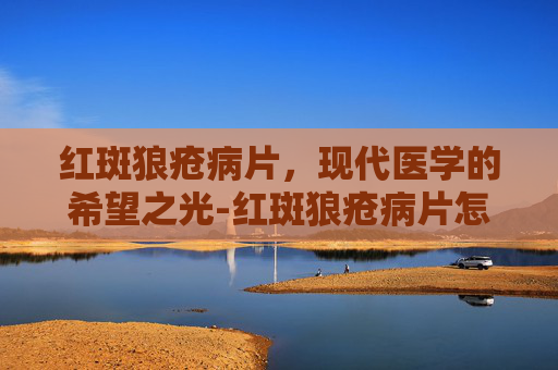 红斑狼疮病片，现代医学的希望之光-红斑狼疮病片怎么治疗