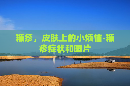 糠疹，皮肤上的小烦恼-糠疹症状和图片