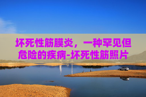 坏死性筋膜炎，一种罕见但危险的疾病-坏死性筋照片图片