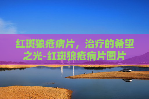 红斑狼疮病片，治疗的希望之光-红斑狼疮病片图片