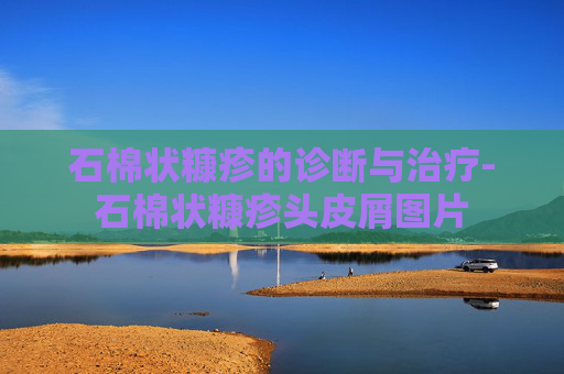 石棉状糠疹的诊断与治疗-石棉状糠疹头皮屑图片